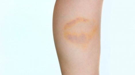 La thrombose dans les poumons